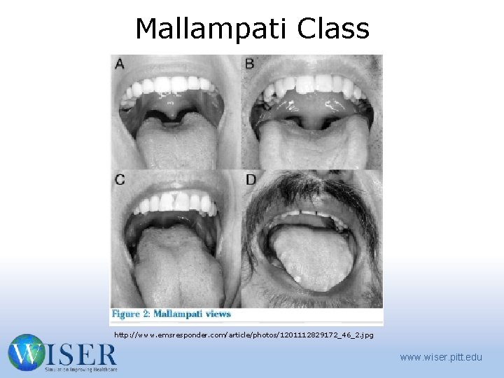 Mallampati Class http: //www. emsresponder. com/article/photos/1201112829172_46_2. jpg www. wiser. pitt. edu 