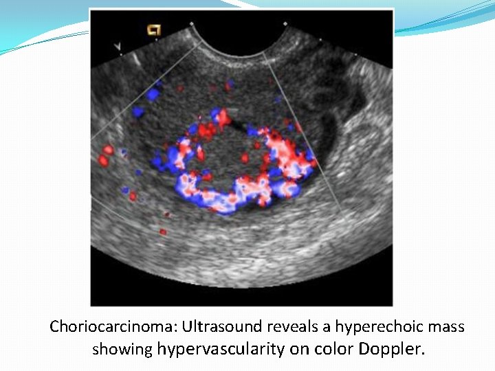 Choriocarcinoma: Ultrasound reveals a hyperechoic mass showing hypervascularity on color Doppler. 