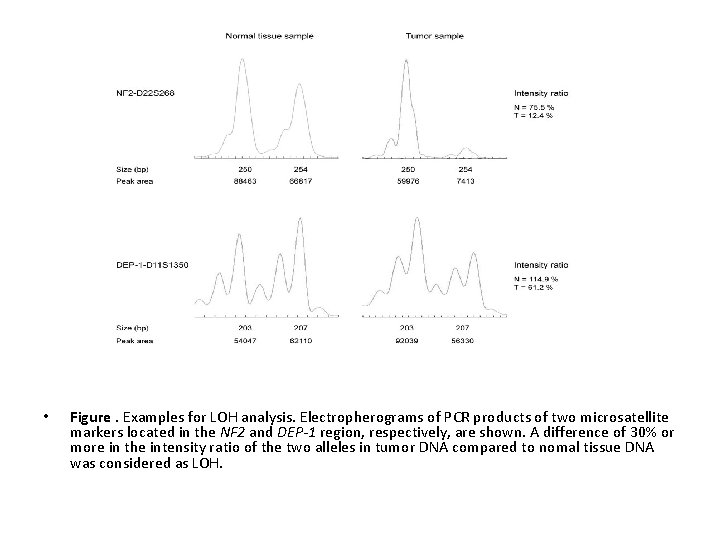  • Figure. Examples for LOH analysis. Electropherograms of PCR products of two microsatellite
