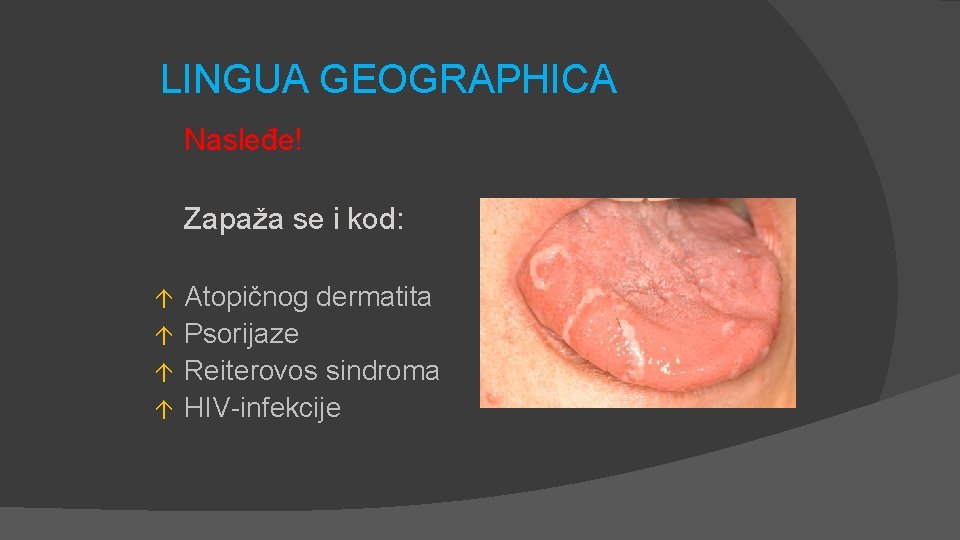 LINGUA GEOGRAPHICA Nasleđe! Zapaža se i kod: Atopičnog dermatita á Psorijaze á Reiterovos sindroma