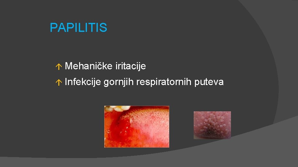 PAPILITIS á Mehaničke á Infekcije iritacije gornjih respiratornih puteva 