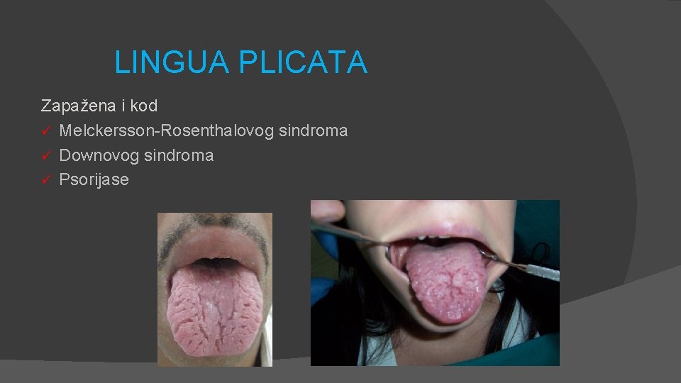 LINGUA PLICATA Zapažena i kod ü Melckersson-Rosenthalovog sindroma ü Downovog sindroma ü Psorijase 