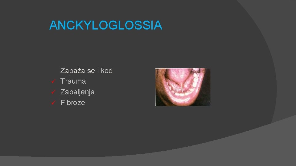 ANCKYLOGLOSSIA Zapaža se i kod ü Trauma ü Zapaljenja ü Fibroze 