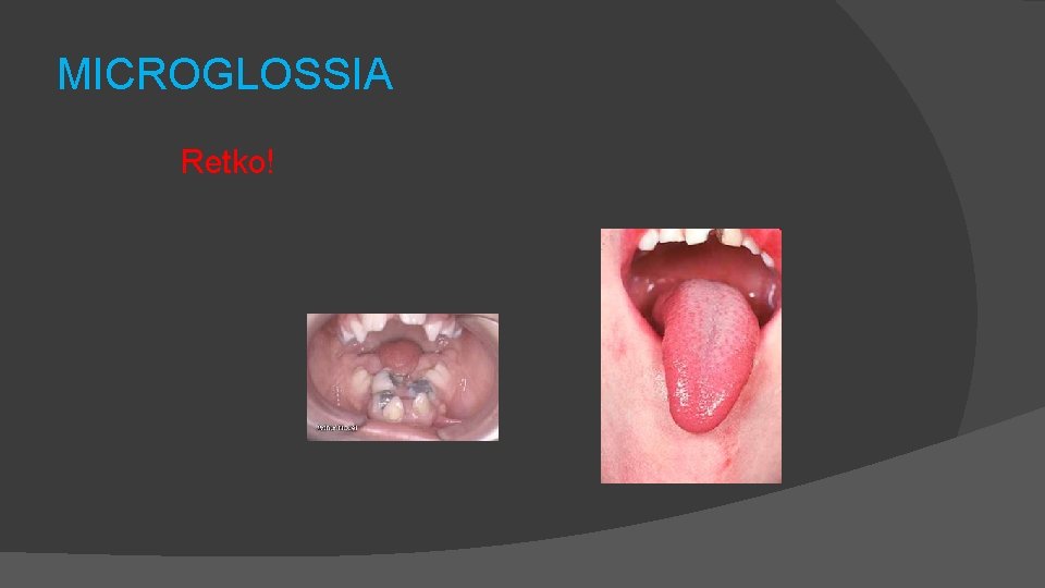 MICROGLOSSIA Retko! 