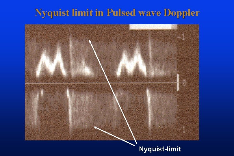 Nyquist limit in Pulsed wave Doppler Nyquist-limit 