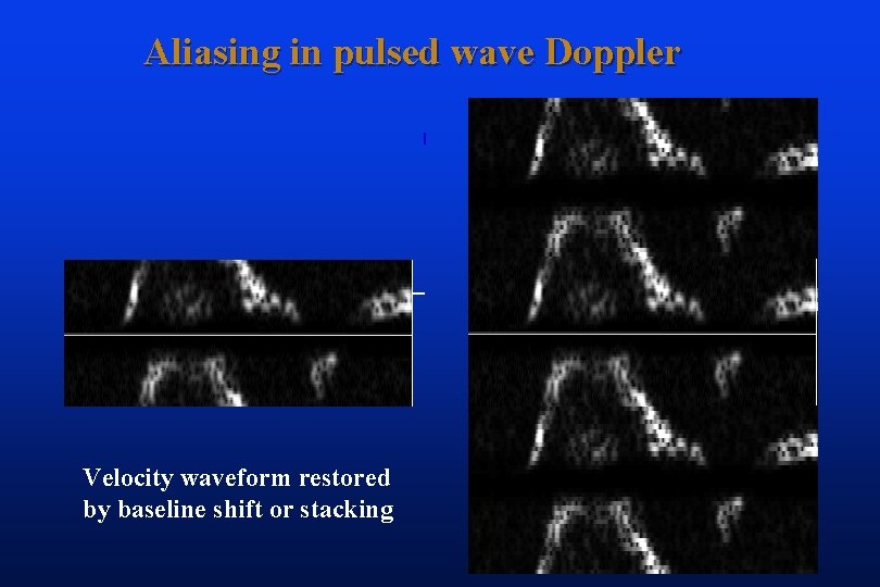 Aliasing in pulsed wave Doppler Velocity waveform restored by baseline shift or stacking 