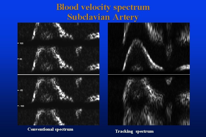 Blood velocity spectrum Subclavian Artery 100 50 -100 Conventional spectrum Tracking spectrum 