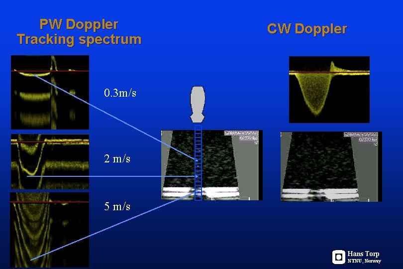 PW Doppler Tracking spectrum CW Doppler 0. 3 m/s 2 m/s . 5 m/s