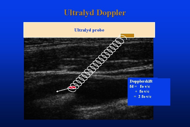 Ultralyd Doppler Ultralyd probe Dopplerskift fd == fo v/c + fo v/c = 2