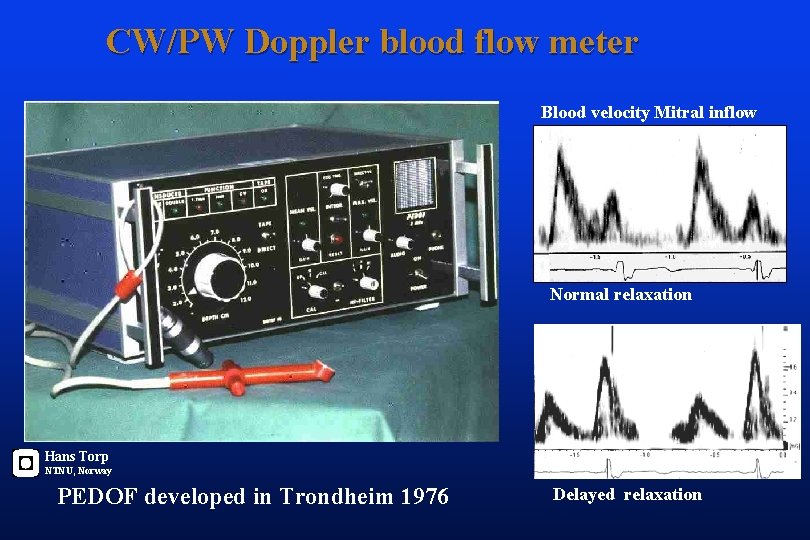 CW/PW Doppler blood flow meter Blood velocity Mitral inflow Velocity time Normal relaxation Hans