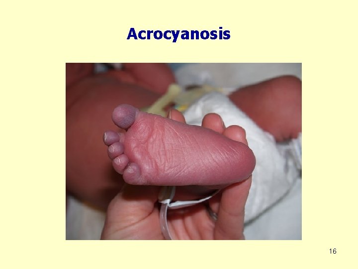 Acrocyanosis 16 
