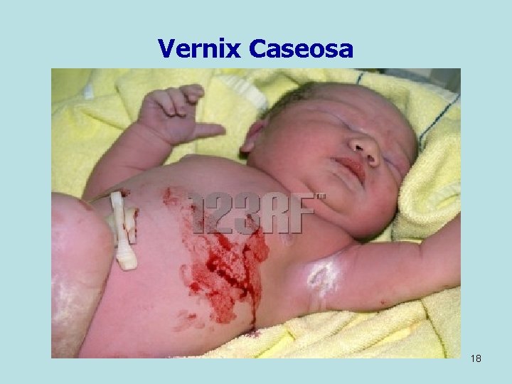 Vernix Caseosa 18 