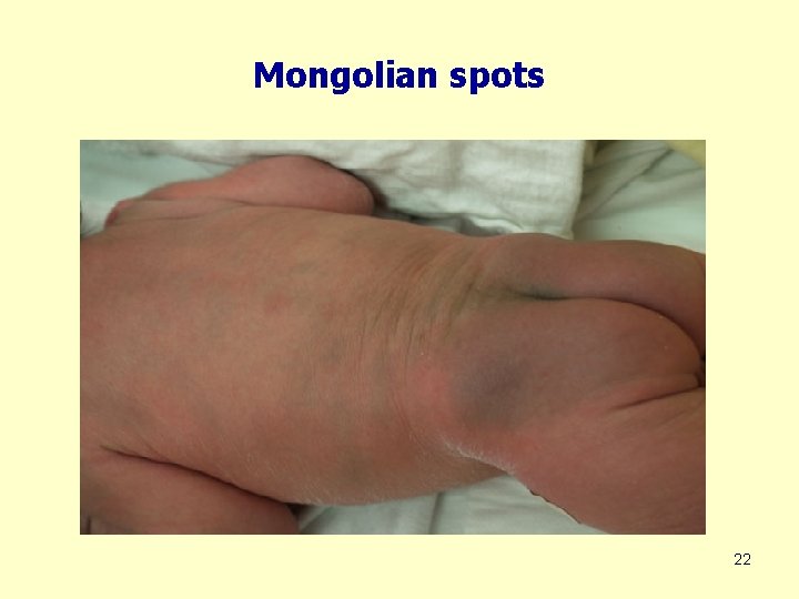 Mongolian spots 22 