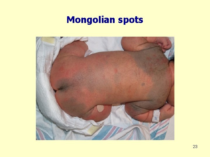 Mongolian spots 23 