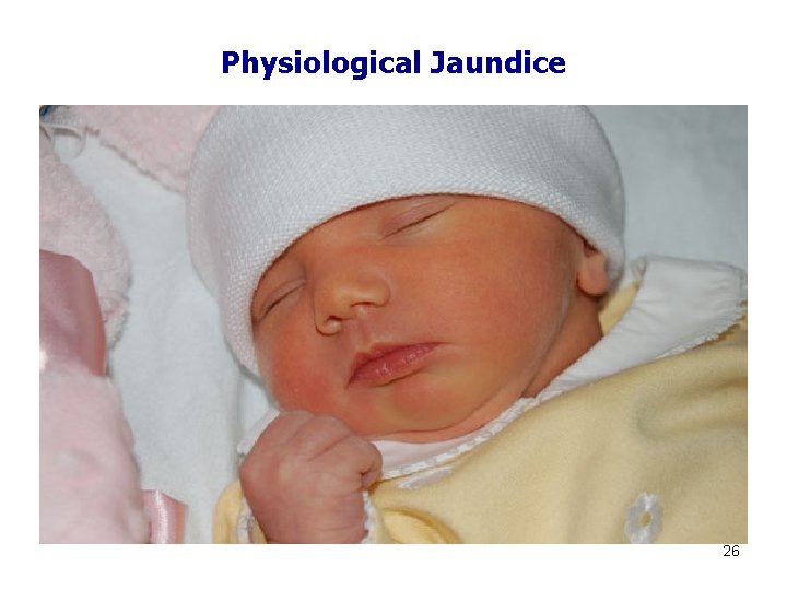 Physiological Jaundice 26 