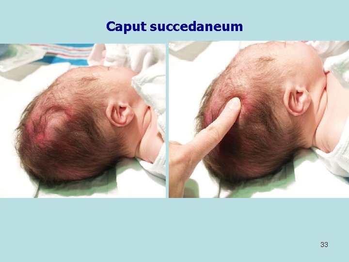 Caput succedaneum 33 
