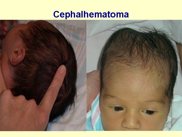Cephalhematoma 36 
