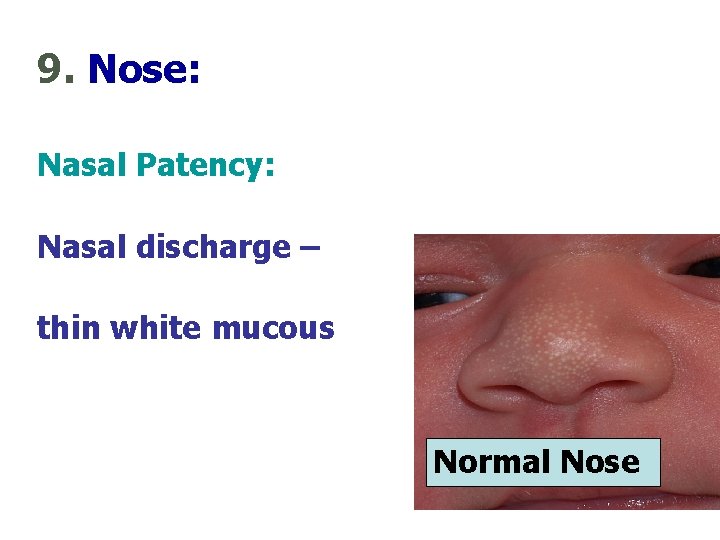 9. Nose: Nasal Patency: Nasal discharge – thin white mucous Normal Nose 46 