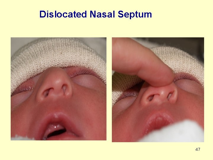 Dislocated Nasal Septum 47 