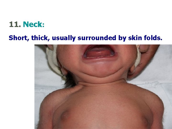 11. Neck: Short, thick, usually surrounded by skin folds. 49 