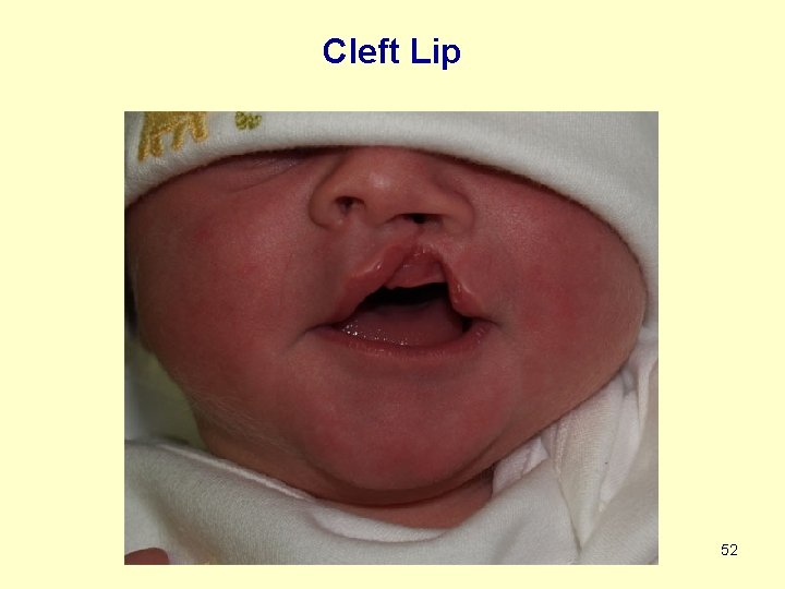 Cleft Lip 52 