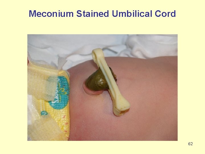 Meconium Stained Umbilical Cord 62 