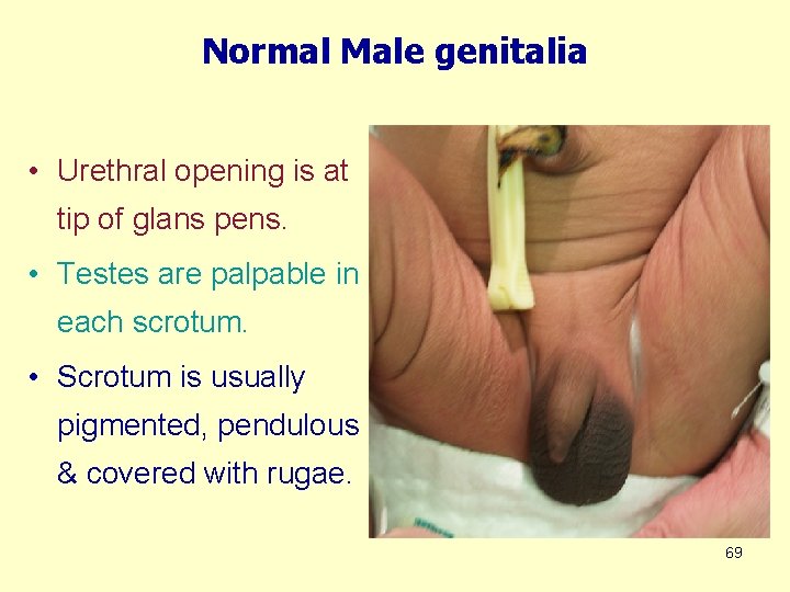 Normal Male genitalia • Urethral opening is at tip of glans pens. • Testes