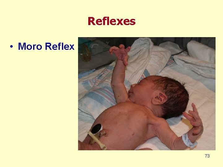 Reflexes • Moro Reflex 73 