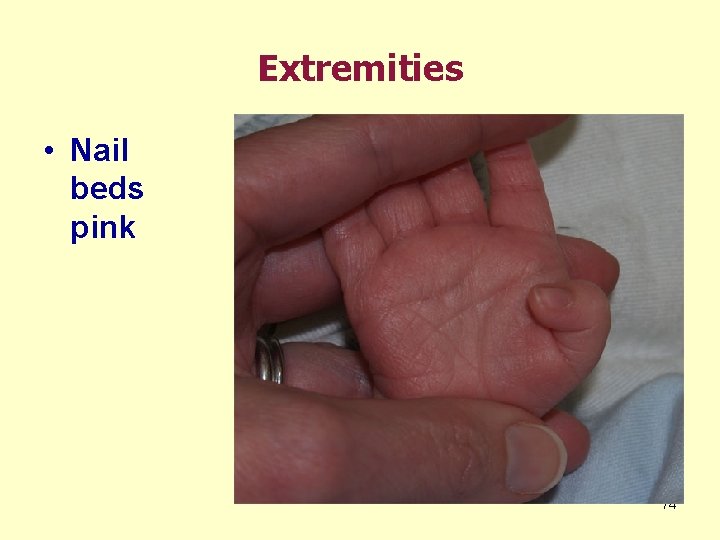 Extremities • Nail beds pink 74 