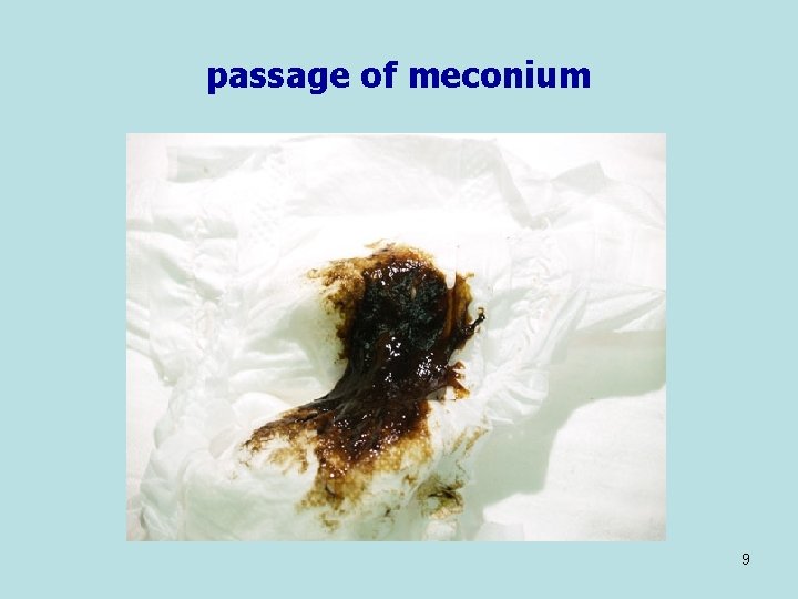passage of meconium 9 
