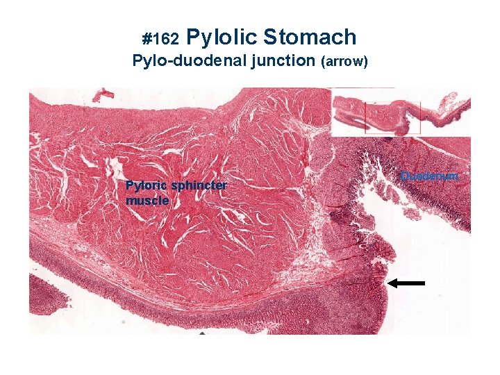 #162 Pylolic Stomach Pylo-duodenal junction (arrow) Pyloric sphincter muscle Duodenum 