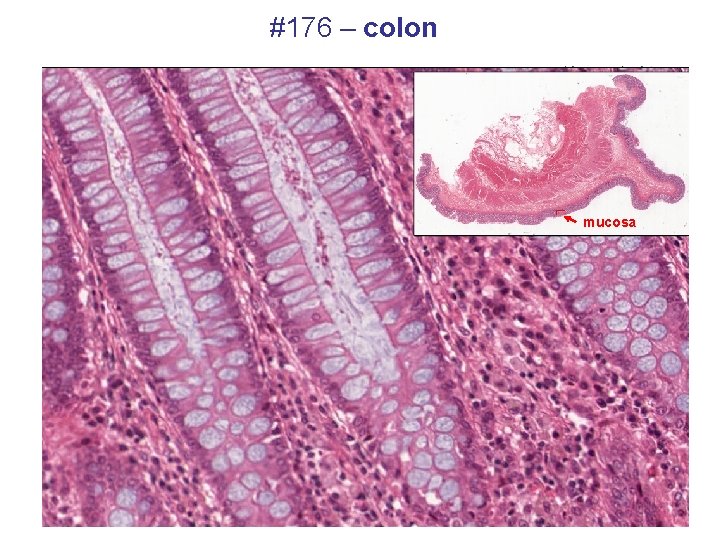 #176 – colon mucosa 