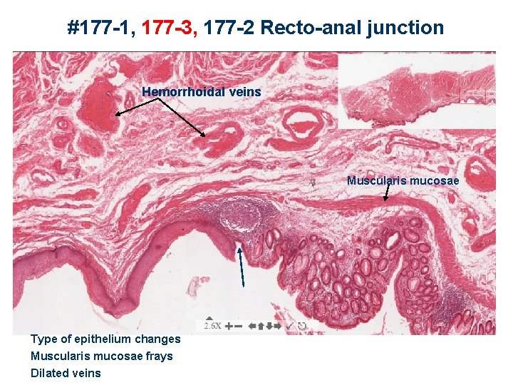 #177 -1, 177 -3, 177 -2 Recto-anal junction Hemorrhoidal veins Muscularis mucosae Type of