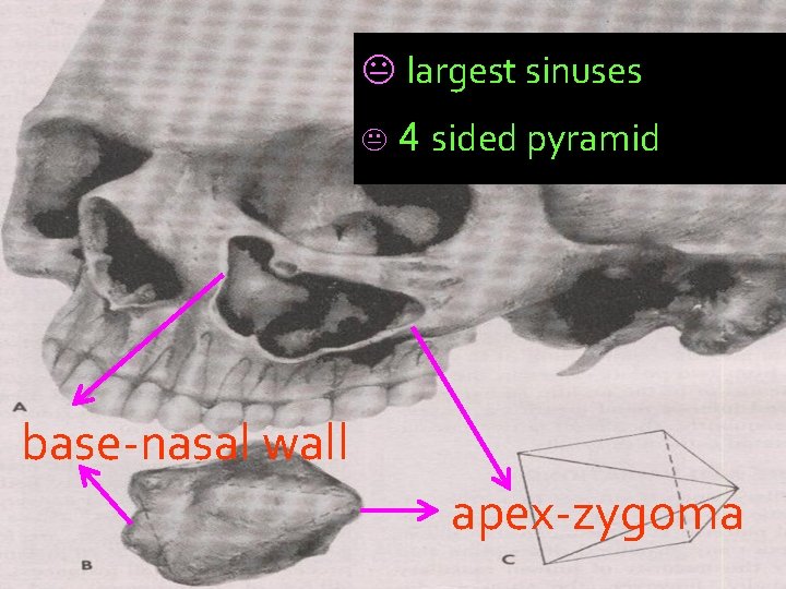 K largest sinuses K 4 sided pyramid base-nasal wall apex-zygoma 