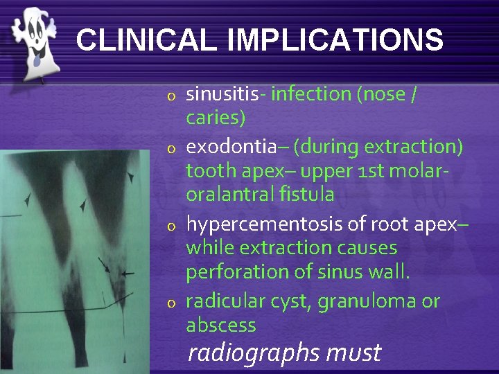 CLINICAL IMPLICATIONS o o sinusitis- infection (nose / caries) exodontia– (during extraction) tooth apex–