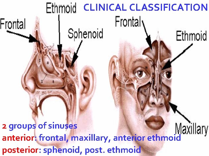 CLINICAL CLASSIFICATION 2 groups of sinuses anterior: frontal, maxillary, anterior ethmoid Dr. MANISH posterior: