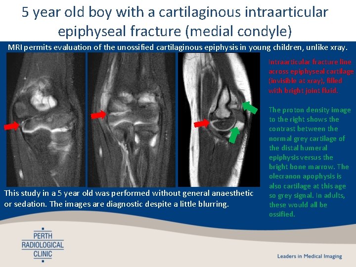 5 year old boy with a cartilaginous intraarticular epiphyseal fracture (medial condyle) MRI permits