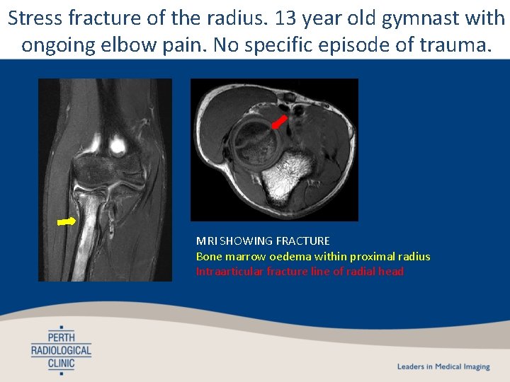 Stress fracture of the radius. 13 year old gymnast with ongoing elbow pain. No