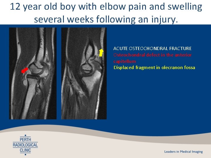 12 year old boy with elbow pain and swelling several weeks following an injury.