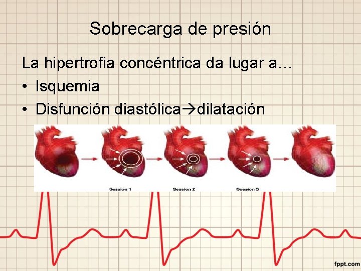 Sobrecarga de presión La hipertrofia concéntrica da lugar a… • Isquemia • Disfunción diastólica