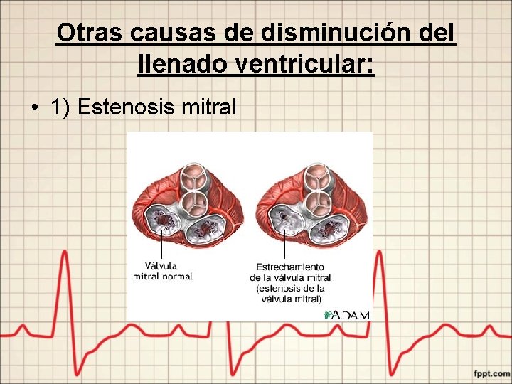 Otras causas de disminución del llenado ventricular: • 1) Estenosis mitral 