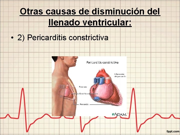 Otras causas de disminución del llenado ventricular: • 2) Pericarditis constrictiva 