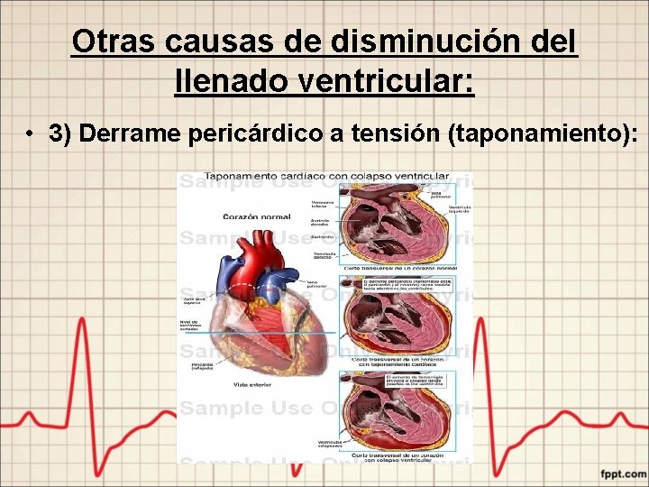 Otras causas de disminución del llenado ventricular: • 3) Derrame pericárdico a tensión (taponamiento):