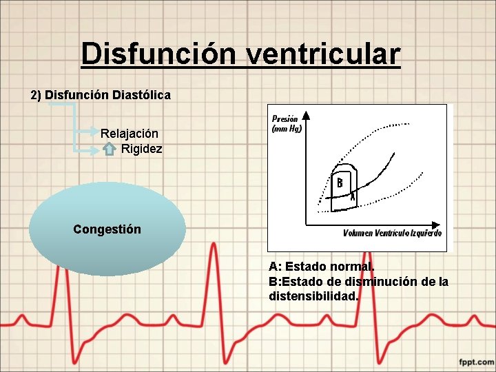 Disfunción ventricular 2) Disfunción Diastólica Relajación Rigidez Congestión A: Estado normal. B: Estado de