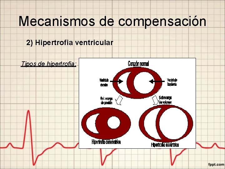 Mecanismos de compensación 2) Hipertrofia ventricular Tipos de hipertrofia: 