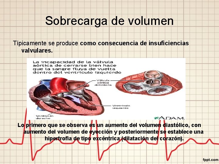 Sobrecarga de volumen Típicamente se produce como consecuencia de insuficiencias valvulares. Lo primero que