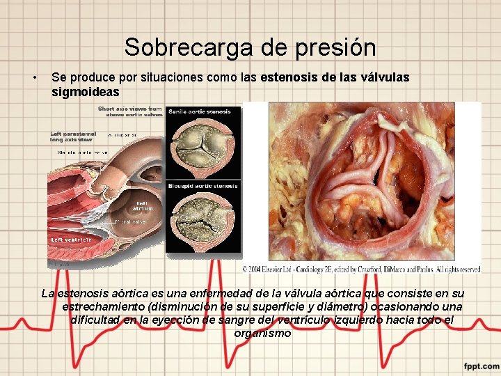 Sobrecarga de presión • Se produce por situaciones como las estenosis de las válvulas