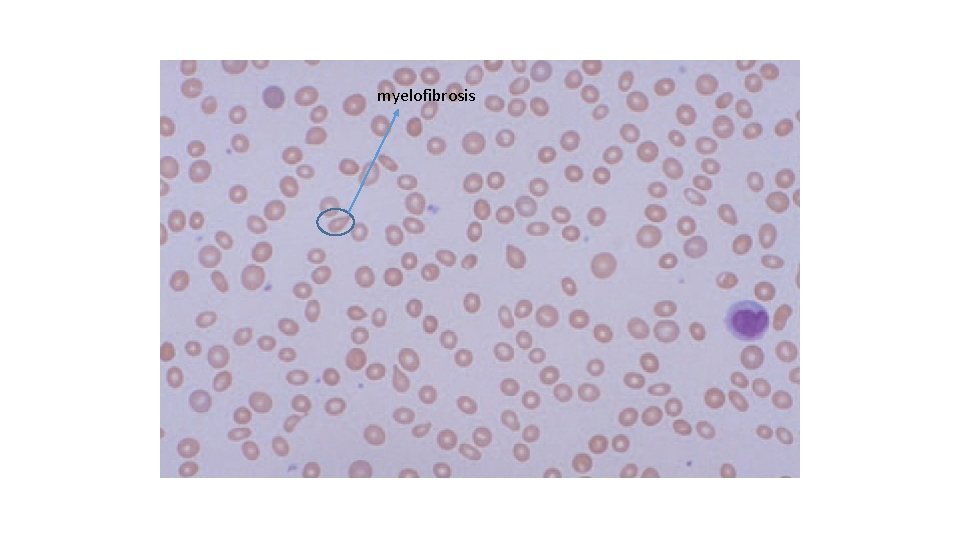 myelofibrosis 