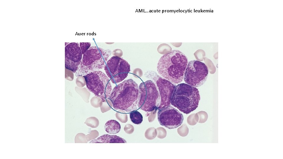AML…acute promyelocytic leukemia Auer rods 