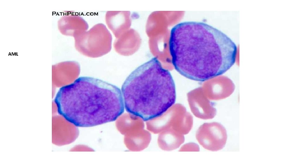 AML 